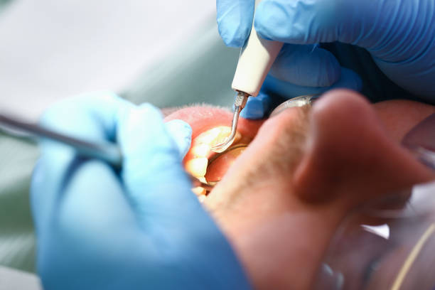 Best Chipped Tooth Repair Near Me  in Remgton, IN